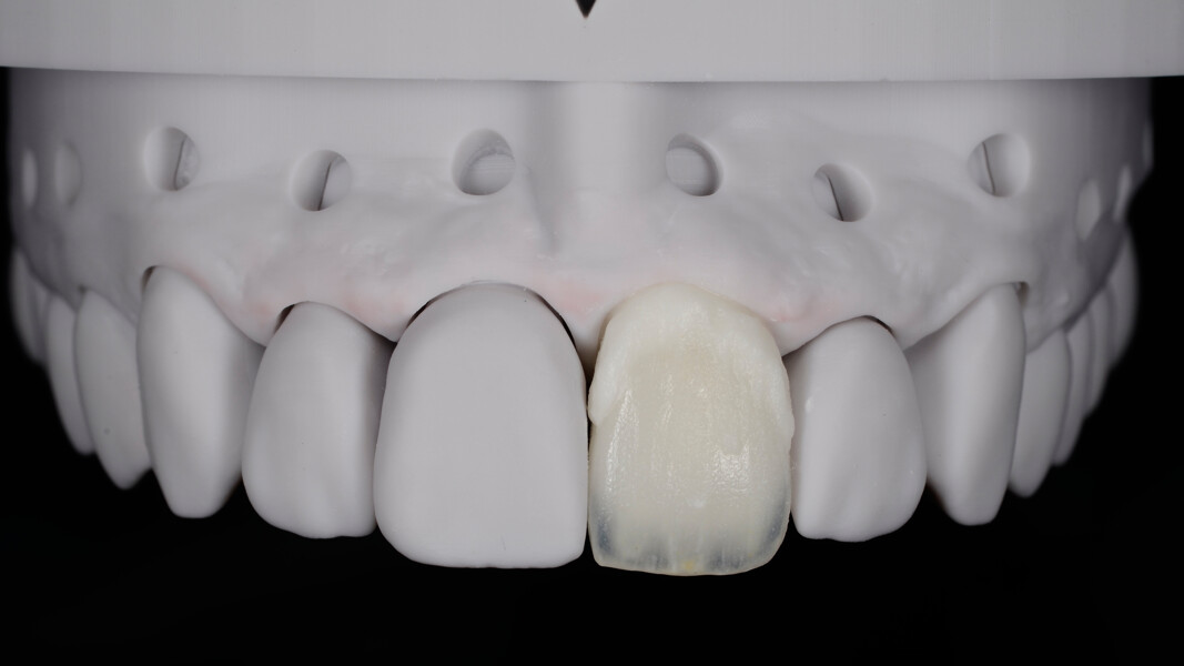 Fig. 21: Application of CERABIEN ZR Luster using the interchangeable build-up technique; CERABIEN ZR Clear Cervical in Shade CCV-1 applied in the cervical area.