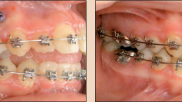 Mini vít: Một tiêu điểm trong thực hành (Phần 3/6)