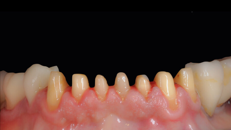 Figg. 2, 3_Preparazione gruppo frontale da 33 a 43.