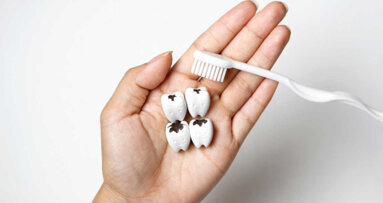 De nouvelles obturations antibactériennes contre les caries dentaires récurrentes