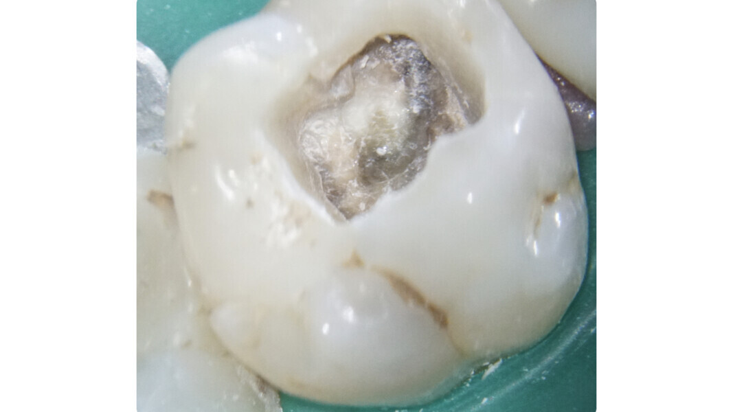 Fig. 28: Identification of white dots of dentinal powder accumulated in correspondence with the canal orifices during the selective removal action with the EndoTracer bur. 