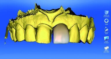 Réhabilitation esthétique antérieure par CFAO directe : à propos d’un cas clinique