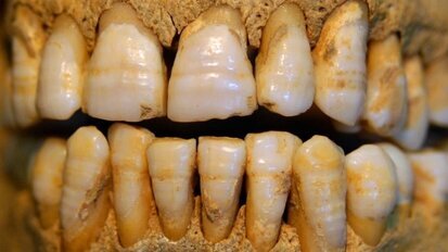 Ipoplasia dello smalto in un soggetto proveniente da un sito tardo medievale di Volpiano (To)