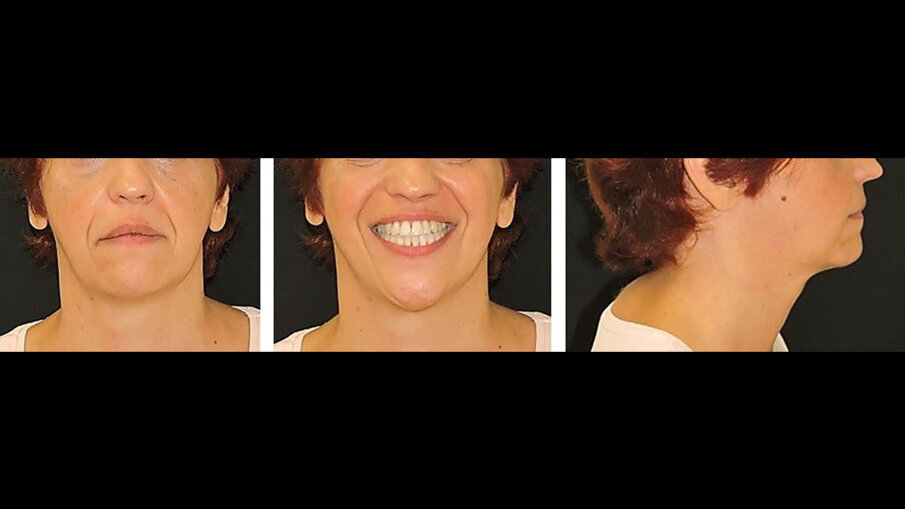 Fig. 13_Immagini extraorali con mantenimento della simmetria scheletrica del viso, dopo 2,5 anni dalla conclusione della terapia.