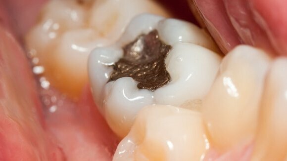 Preocupações relativas a materiais de preenchimento devido à alta incidência de cáries na Índia