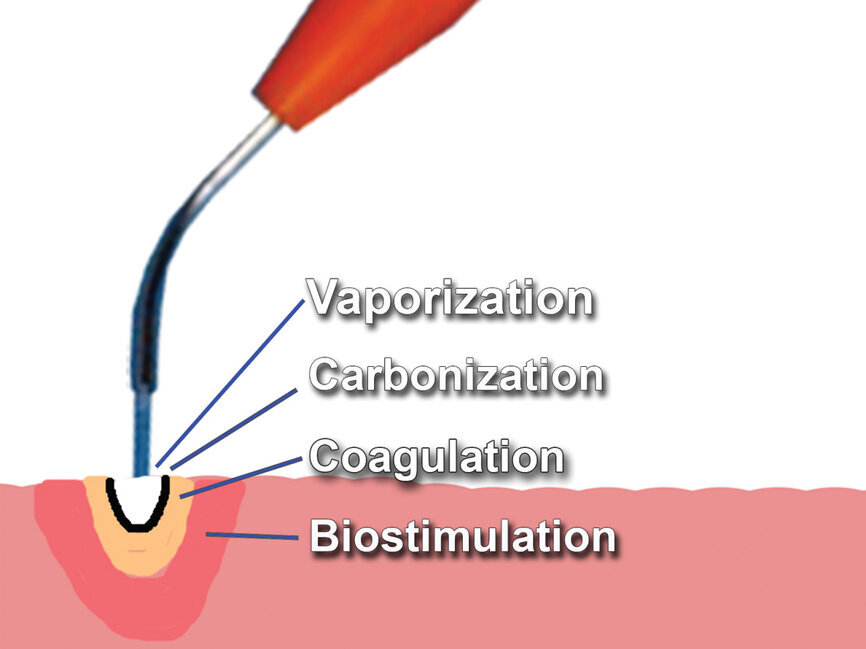 Fig. 3: Tissue reaction upon contact with an initiated diode laser tip, demonstrating the effect as one moves away from the tip. (Photo provided by Dr. Gregori M. Kurtzman)