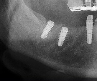 Fig. 15 - Controllo rx a 120 gg. Gli impianti sono integrati nella nuova sede formatasi.