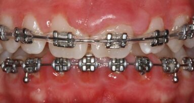 Stałe zdrowie jamy ustnej – estetyczna ortodoncja 30+