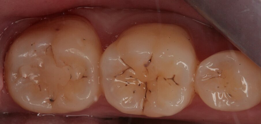 Fig. 19_Restauro presente nell’elemento 37 e solchi interessati dal processo carioso dell’elemento 36.