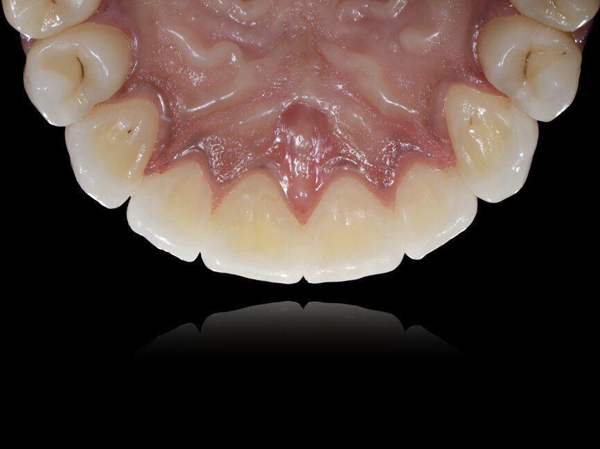 Fig. 83: Initial and final lingual situations.