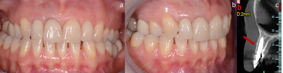 Fig. 5 - Aspetto clinico (a, b) e radiografico (c) della paziente al quinto anno di follow-up. La freccia indica il nuovo strato di osso corticale formatosi.