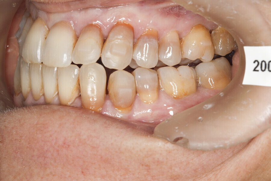 Fig. 45: Situation after 37 Reveal aligners. Case ready for the first refinement. Major change to the patient’s profile.