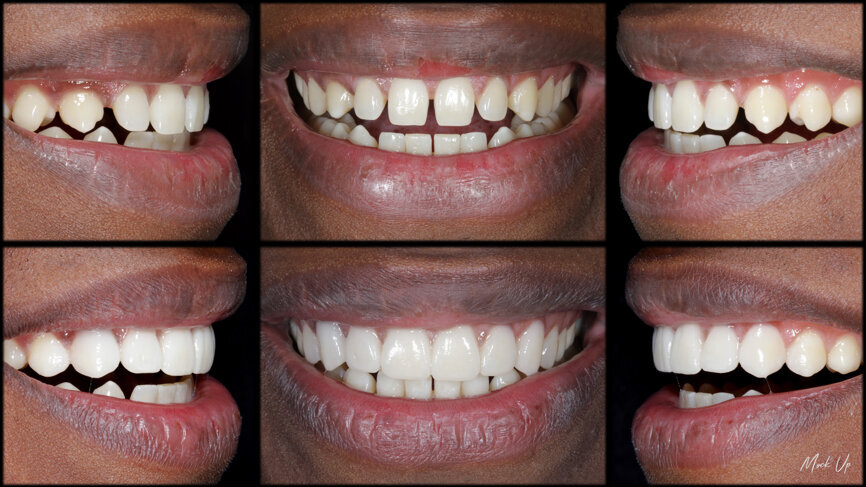 Fig. 49: Mock-up procedures and result in the mouth in order to evaluate the aesthetic relation between the face and the smile.