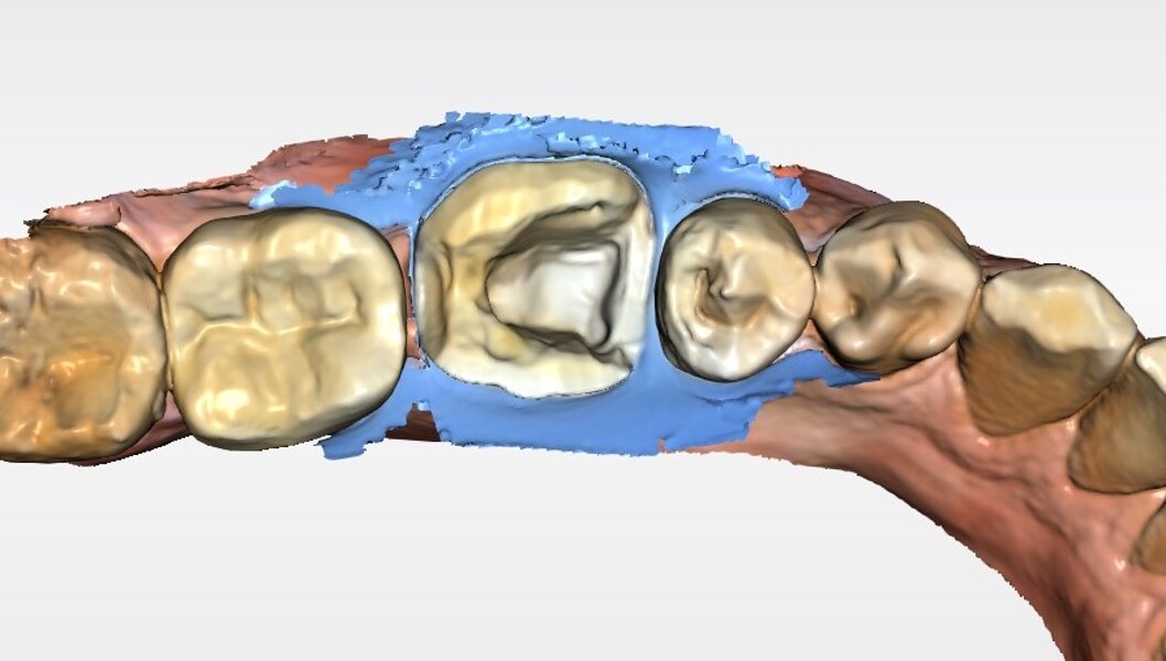 Fig. 19a: CAD workflow for tooth #36: matching of the intra-oral scan of the prepared tooth #36 under dental dam isolation with the initial scan.