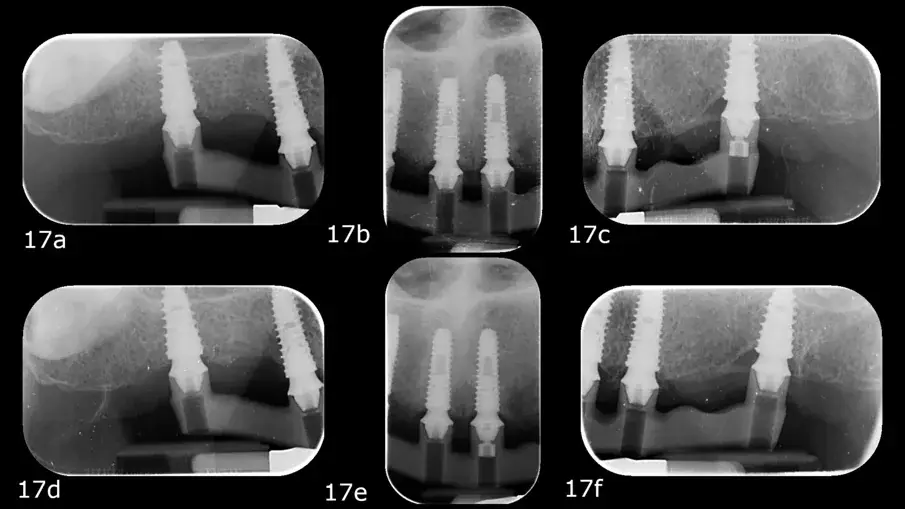 Фиг. 17а–е: Периодични рентгенови снимки по време на теста с един винт.