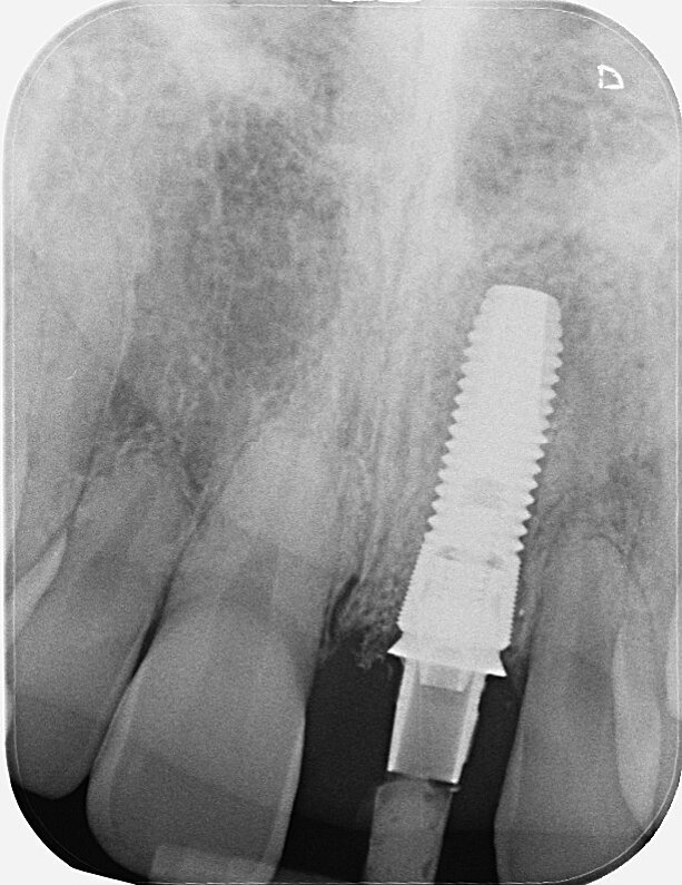 Fig. 19: Ideal osseointegration four months post-op.