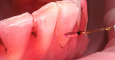 Laser e integratori di lattoferrina per il trattamento miniinvasivo delle black stain: case report