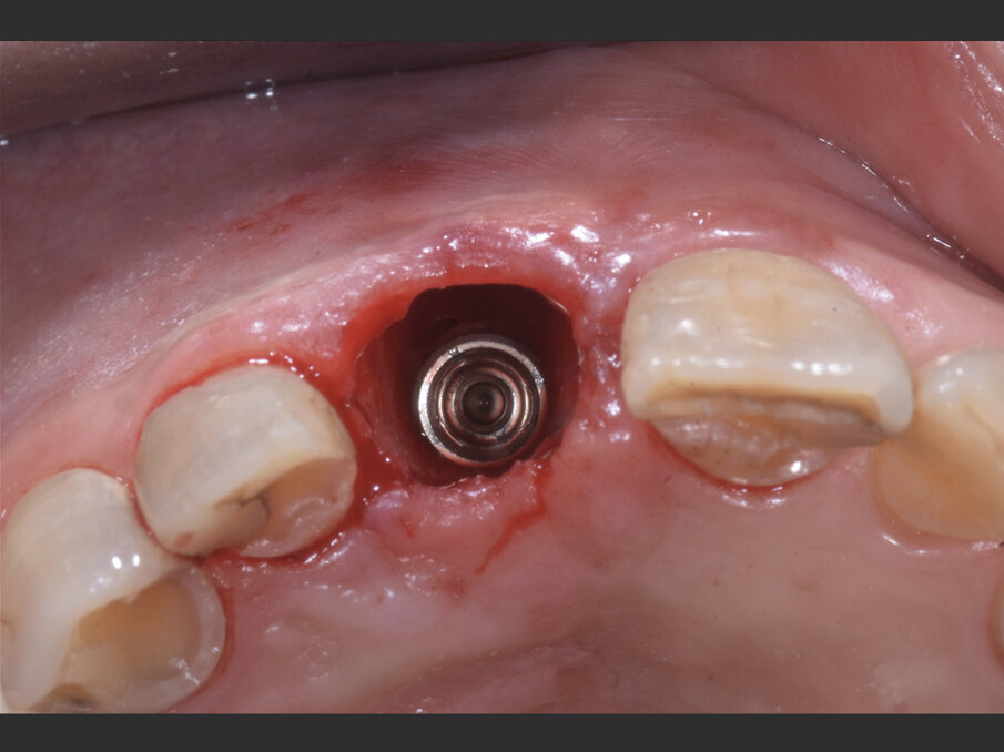 Fig. 4b - Il jumping space tra impianto e corticale ossee viene colmato con Geistlich BioOss Collagen.
