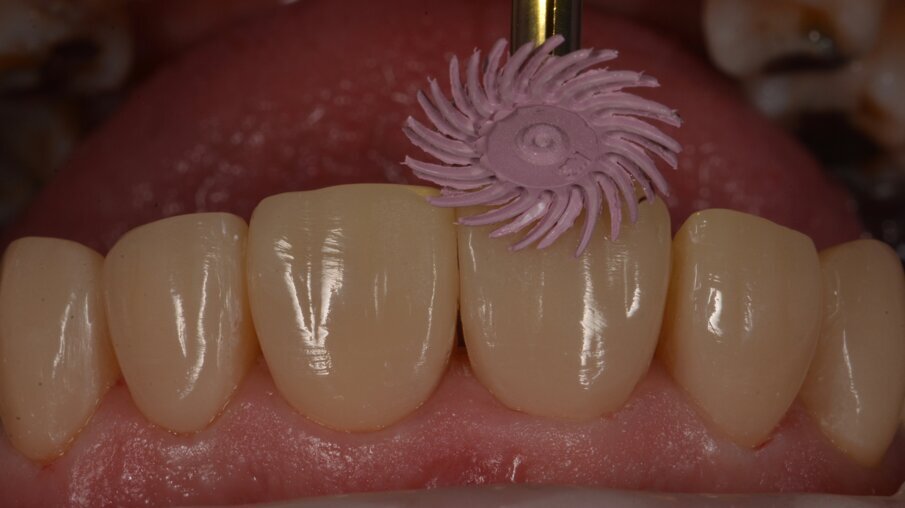 Hoogglans werd bereikt door met de paarse 3MTM Sof-LexTM Spiral te polijsten met hoog toerental met waterkoeling gedurende 5-10 minuten.