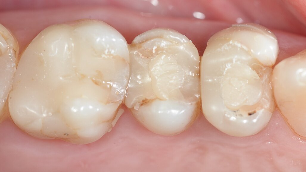 Applicazione di due corone adiacenti con un risultato altamente estetico utilizzando un flusso di lavoro digitale