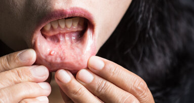 Researchers develop new method for identifying oral cancer