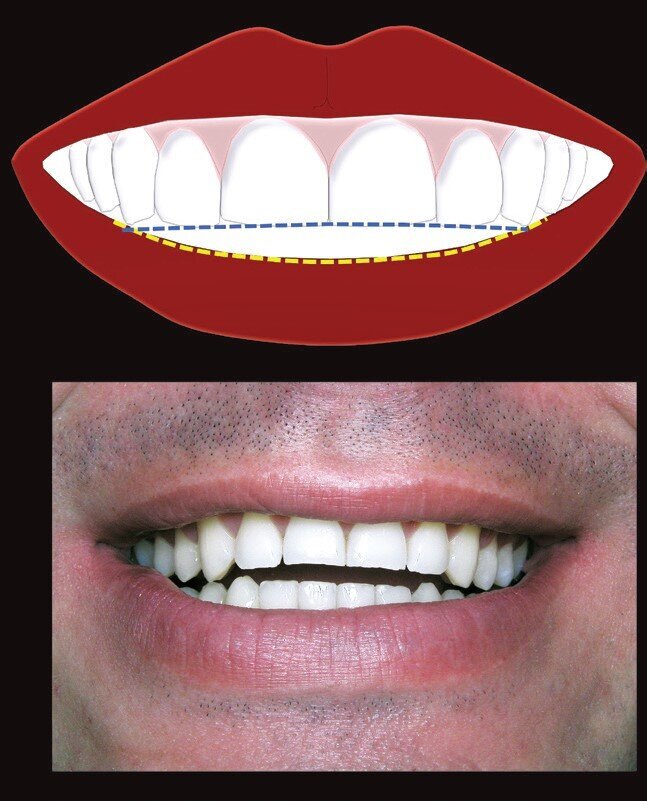 Fig 3: Reverse smile
