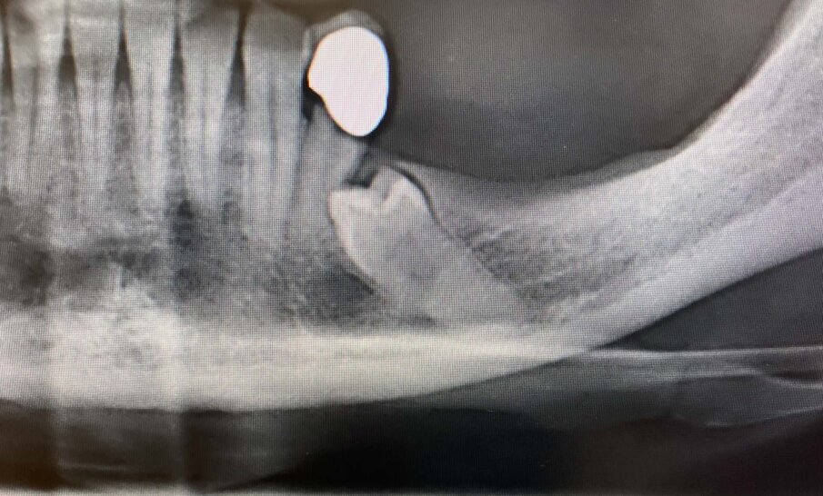Fig. 1 - Ortopanoramica che evidenza l’inclusione del 3.5.