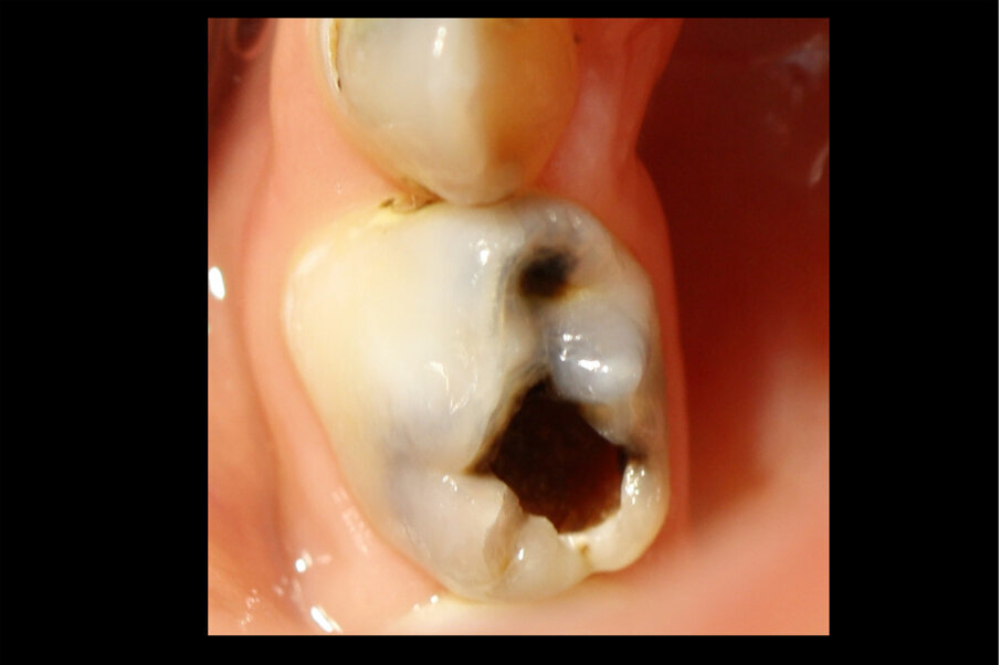 Afbeelding 5. Casus 2: 25-05-18. De caviteit in 74 blijkt niet goed reinigbaar, daarom Fuji Triage geplaatst.
