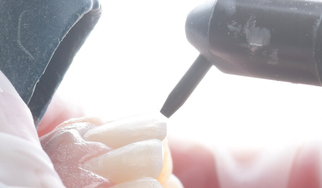 Fig. 4: Air abrasion with 27 μm aluminium oxide particles.