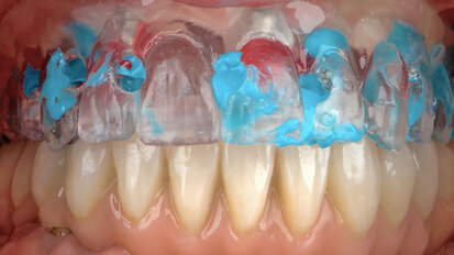 Approccio digitale multidisciplinare per un caso clinico complesso