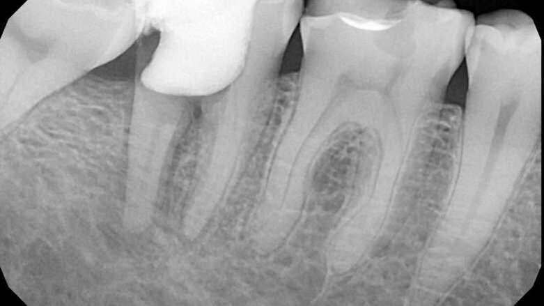 Riješavanje problema neuspjelog endodontskog liječenja zuba