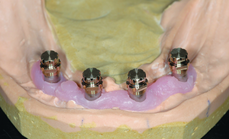 Fig. 9: SynCone caps seated on the abutments on the working cast. An impression of this arrangement is made to fabricate a cast metal frame to reinforce the final restoration.