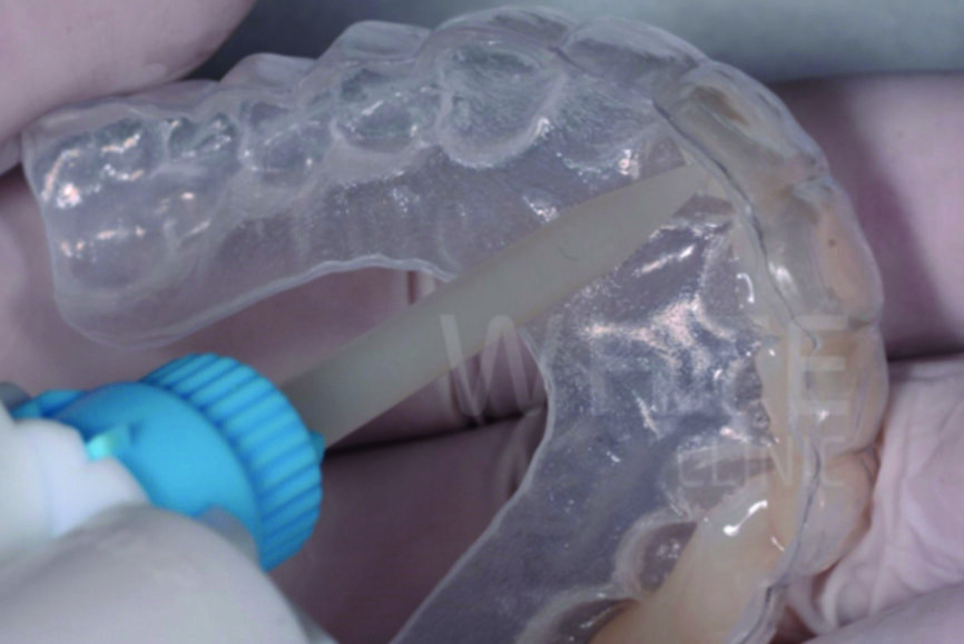 Fig. 6 : Mock-up de confirmation en résine bisacrylique (Structure 3).