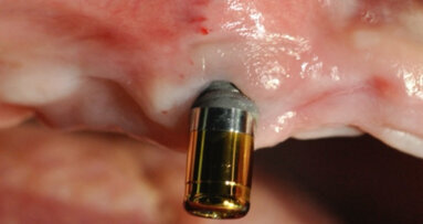 La corrosion des implants dentaires : facteur de risque des péri-implantites. Les implants zircone une alternative préventive