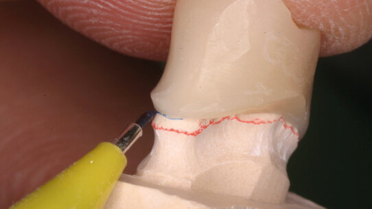 La validazione clinica dei prototipi in protesi fissa in ambiente digitale CAD/CAM