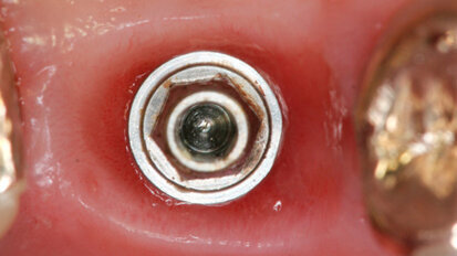 Vantaggi clinici del carico immediato con impianto Cono Morse