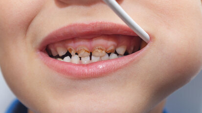 School dental programme prevents 80% of cavities with one-time, non-invasive treatment