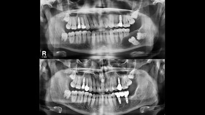 Enucleación de quiste dentígero mandibular y rehabilitación con implantes dentales
