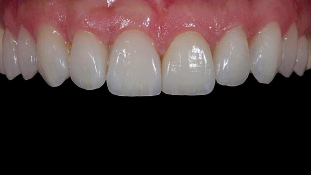 Fig. 15c. Carillas feldespáticas del primer cuadrante y carillas CAD/CAM del segundo cuadrante simultáneamente con pasta de prueba.
