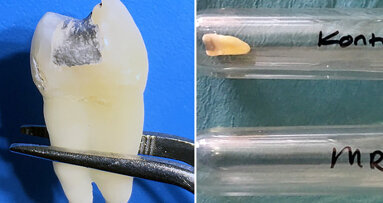 Mercury release from dental amalgam fillings possible on exposure to high strength MRI