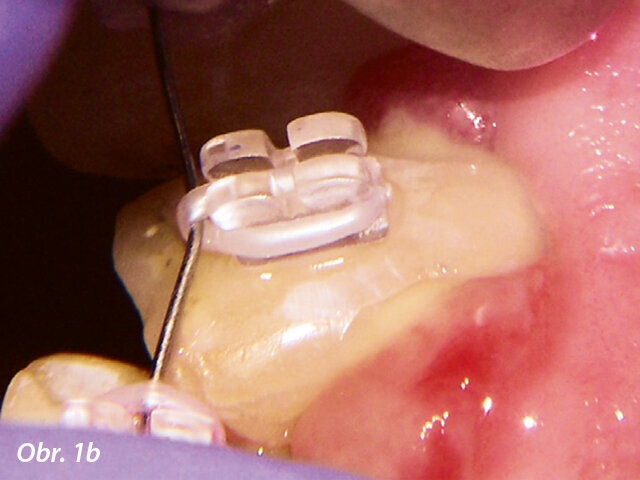 Traumatická intruze, laser byl použit před ortodontickou extruzí kvůli možným bolestem.