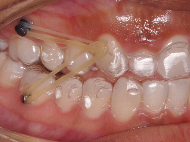 Léčba II. třídy fóliovými aparáty: tahy II. třídy doplněné o tahy I. třídy vedoucí k minišroubům pro vytvoření potřebných vektorů síly.