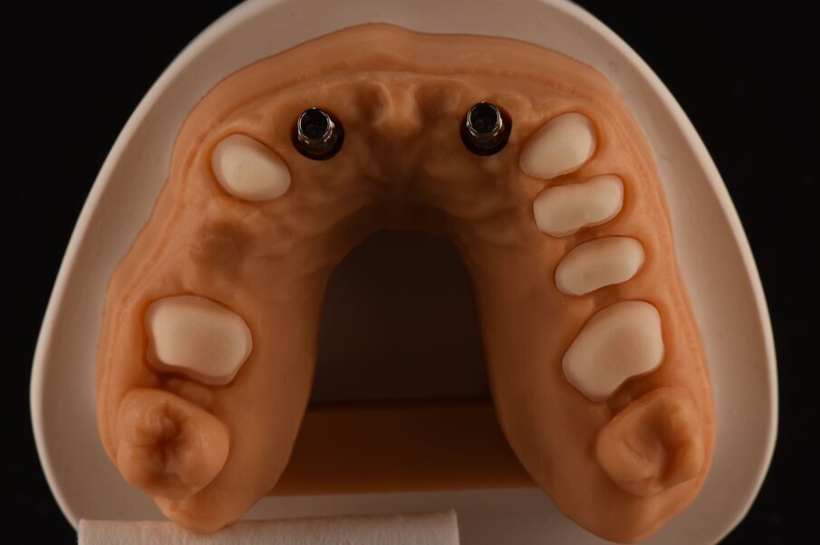 Fig. 34_Dettaglio del modello superiore con la visione palatale, con i monconi t-base da ancoraggio per elementi CAD/CAM.