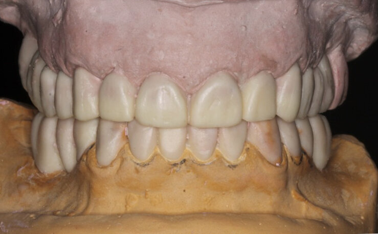 Fig. 3: Wax-up of the planned prosthetic situation
