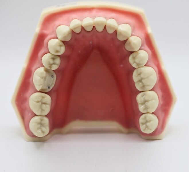 Fig. 6a: Completed pinlay preparation on tooth #36 with the two dentine pins in place, shown in occlusal view.