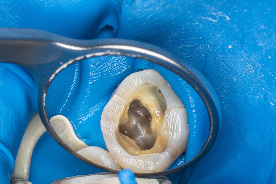 Fig. 13: The maxillary first molar after removal of the temporary restoration and after cusp reduction.