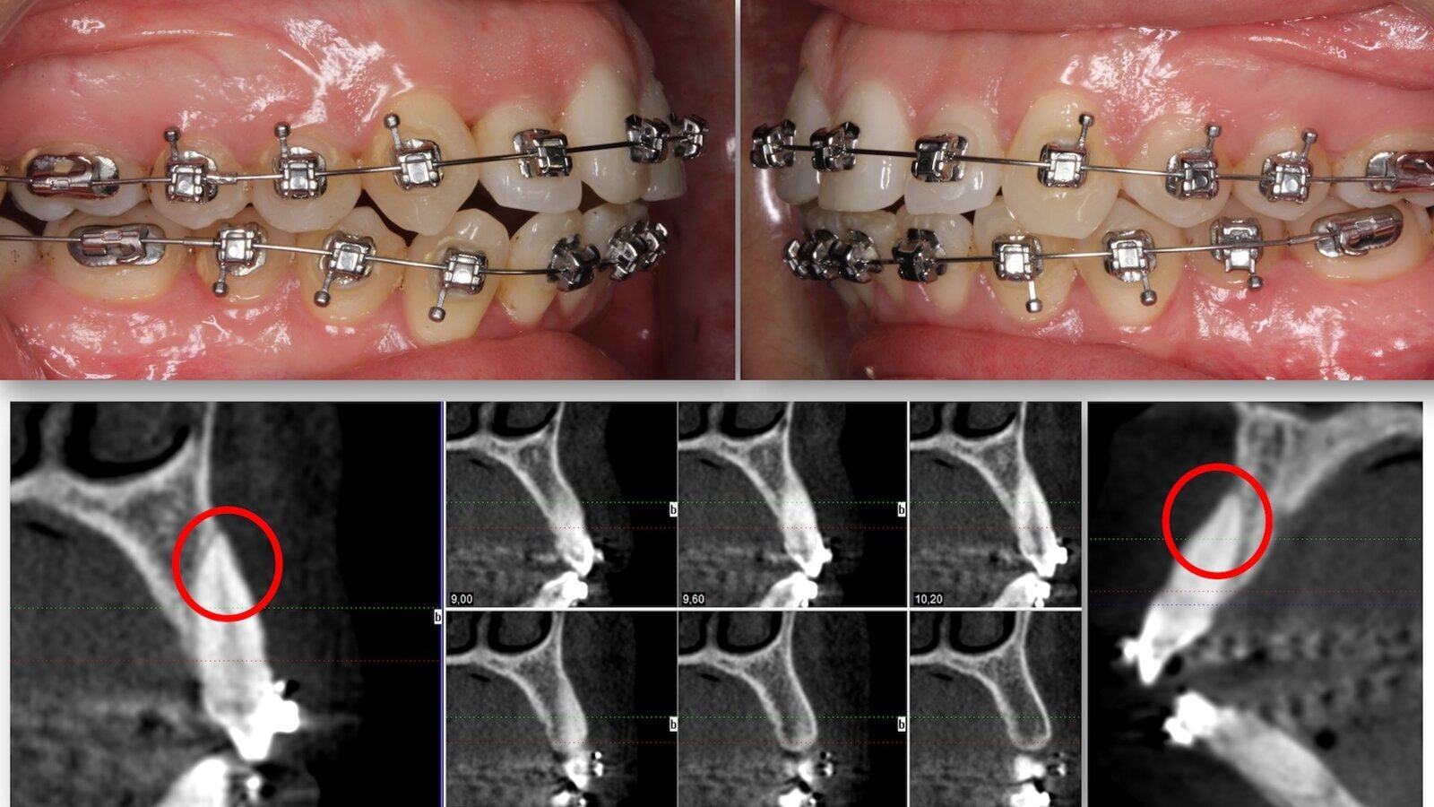 ¿Extracción o Expansión en Ortodoncia? (2)