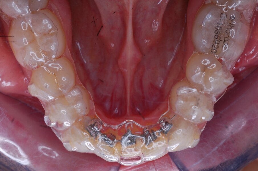 Figg. 34-36_Progressi clinici dopo nove settimane di trattamento con allineato.