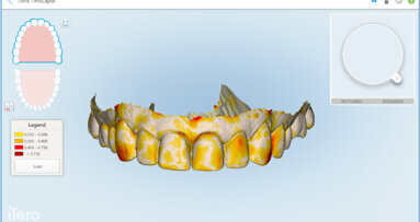 Digital scan reassures patient in veneer treatment Digital scan reassures patient in veneer treatment