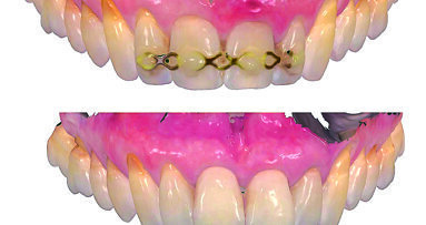 Estetska restauracija nakon traume prednjih zubi